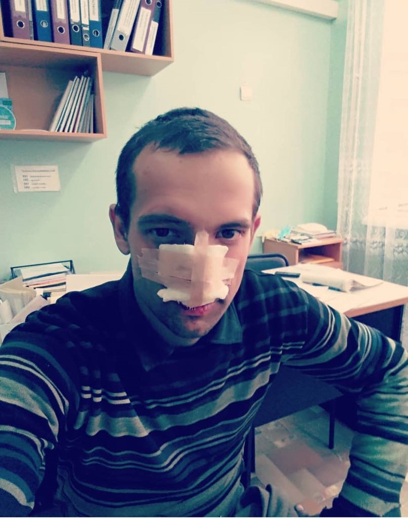 В Запорожской области парень разрезал себе лицо болгаркой (ФОТО)