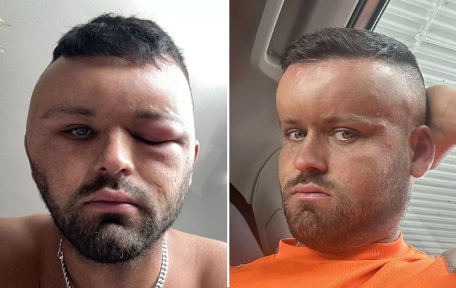 Хотів зафарбувати сивину, а перетворився на героя "Мегамозку": результат шокував навіть лікарів